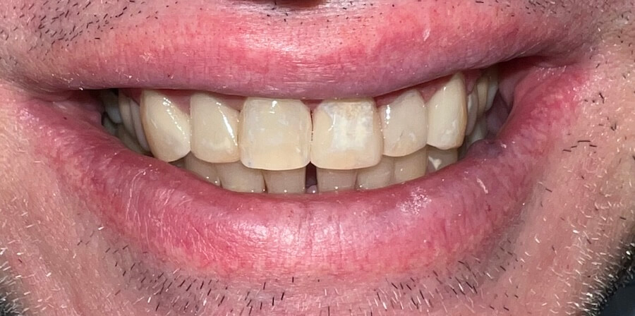Composite Bonding After