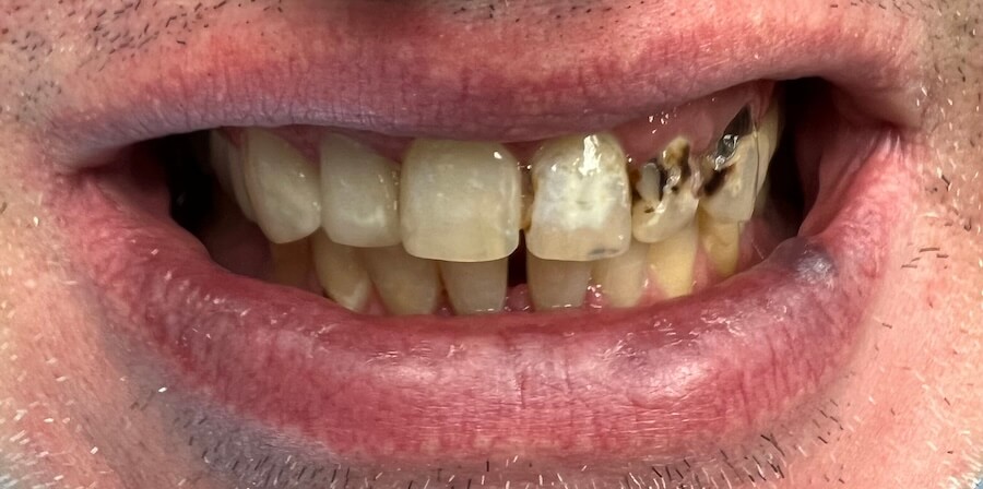 Composite Bonding Before