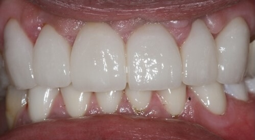 Crowns After
