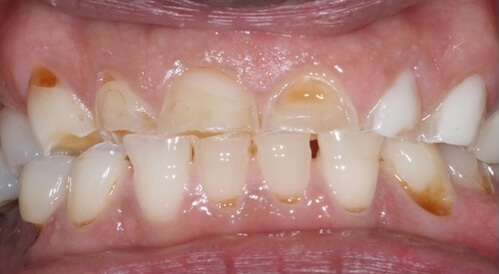 Crowns Before