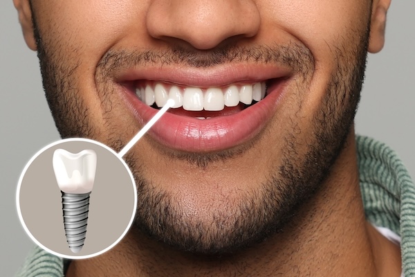 The Ultimate Guide to Dental Implants: What to Expect and Why They're Worth It