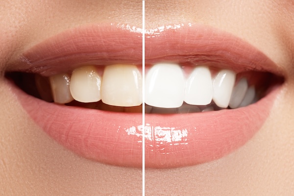 Teeth Whitening Near Silver Comet Trail: What Patients Need to Know