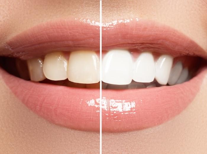 Teeth Whitening Near Silver Comet Trail: What Patients Need to Know